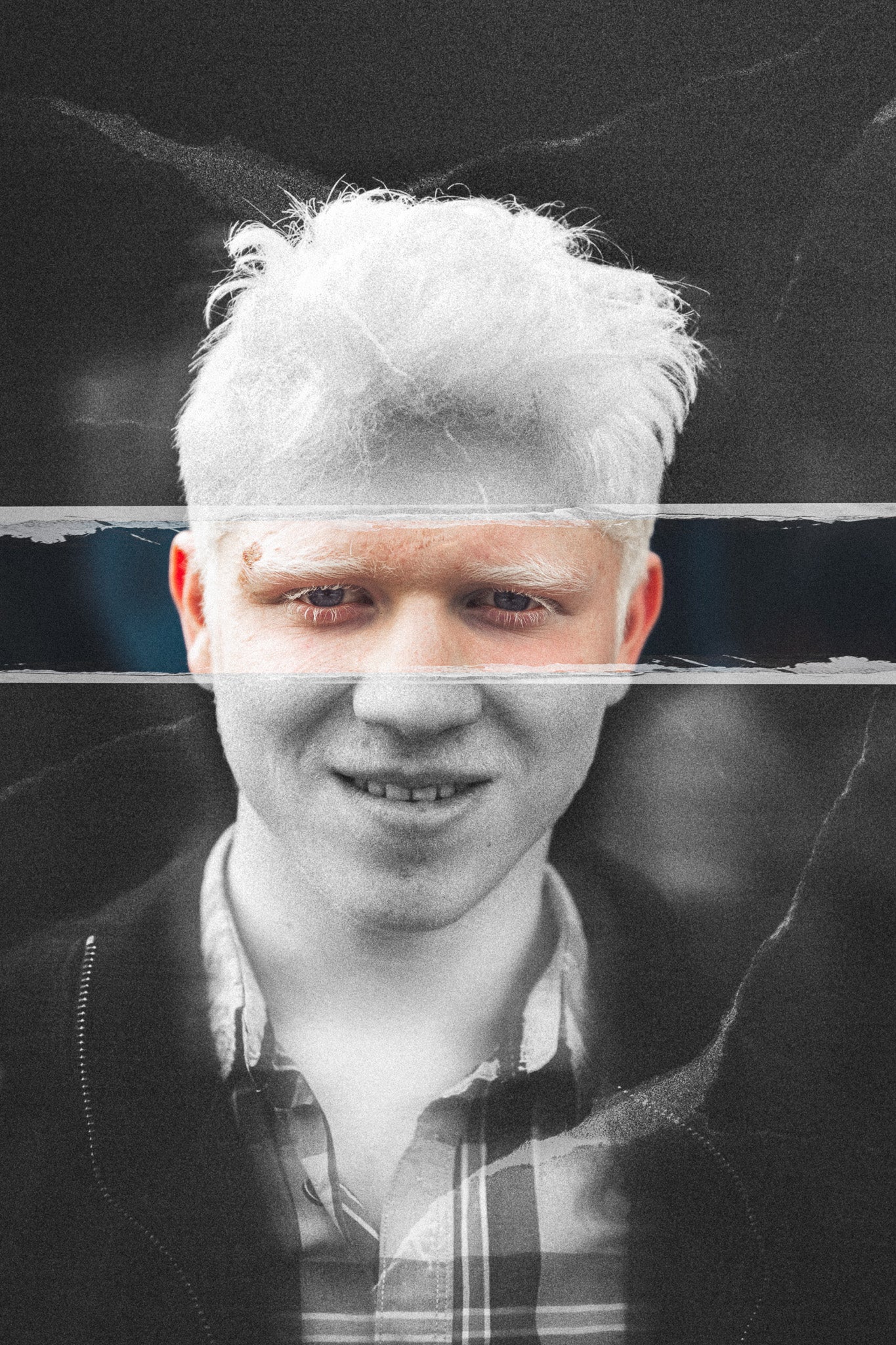 1.2 Albinism